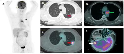 Prognostic Significance of PD-L1 Expression and Standardized Uptake Values in the Primary Lesions of Stage IV Adenocarcinoma Lung Cancer